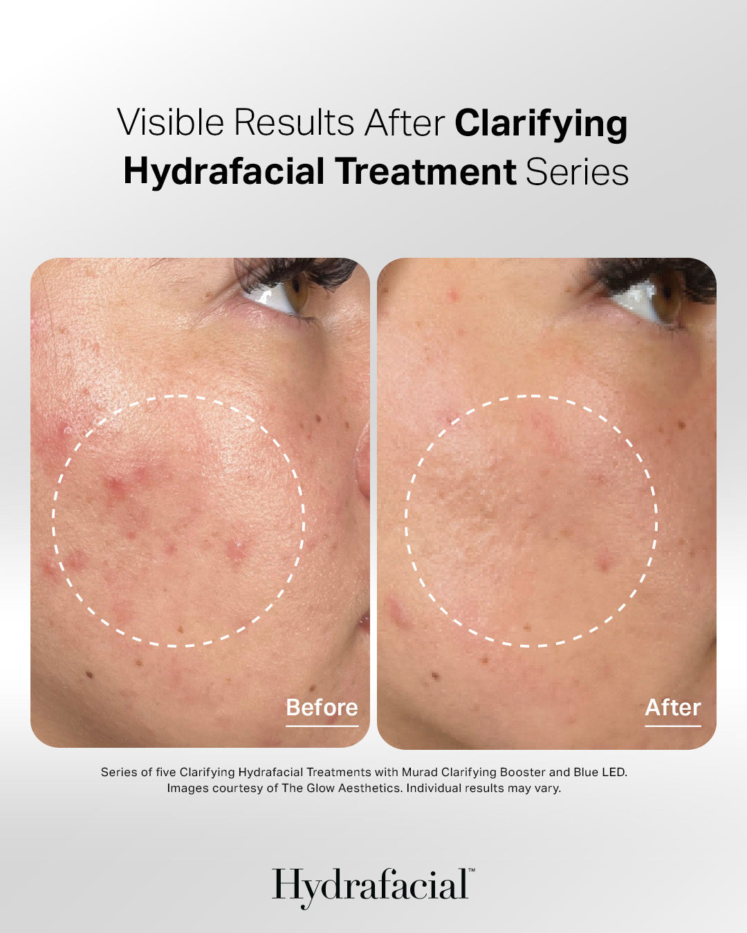 HydraFacial™ Experience